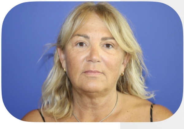 Avant lifting facial liposuccion cervicale — Patiente 4 — Dr Germain Marseille