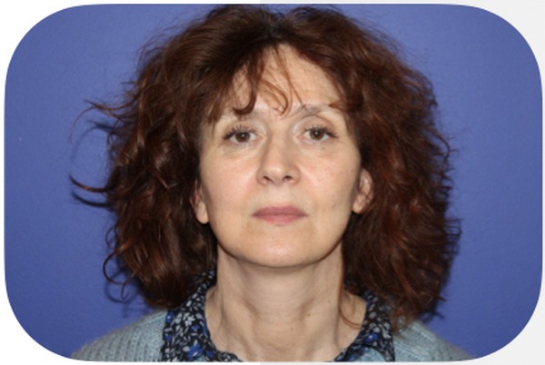 Après lifting facial 1 an — Patiente 5 — Dr Germain Marseille