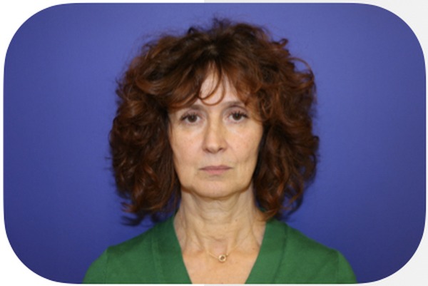 Avant lifting facial — Patiente 5 — Dr Germain Marseille