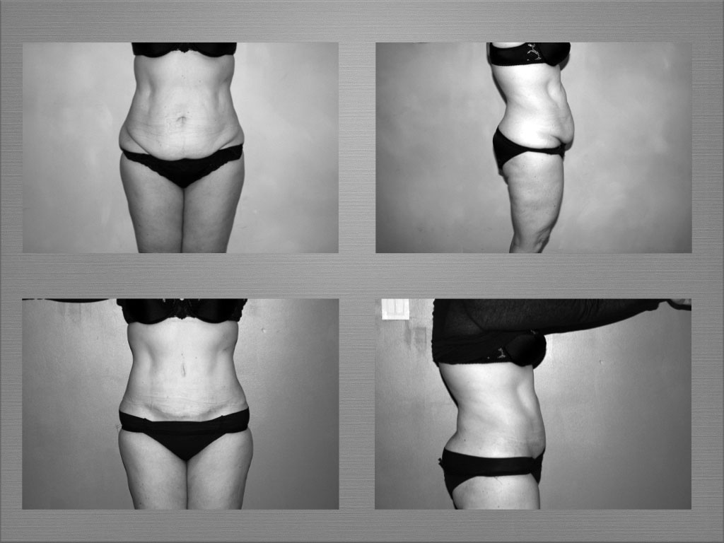 Chirurgie silhouette résultat 1