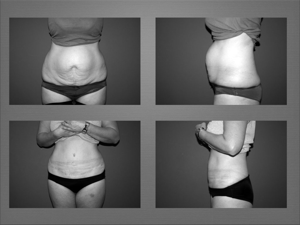 Chirurgie silhouette résultat 2