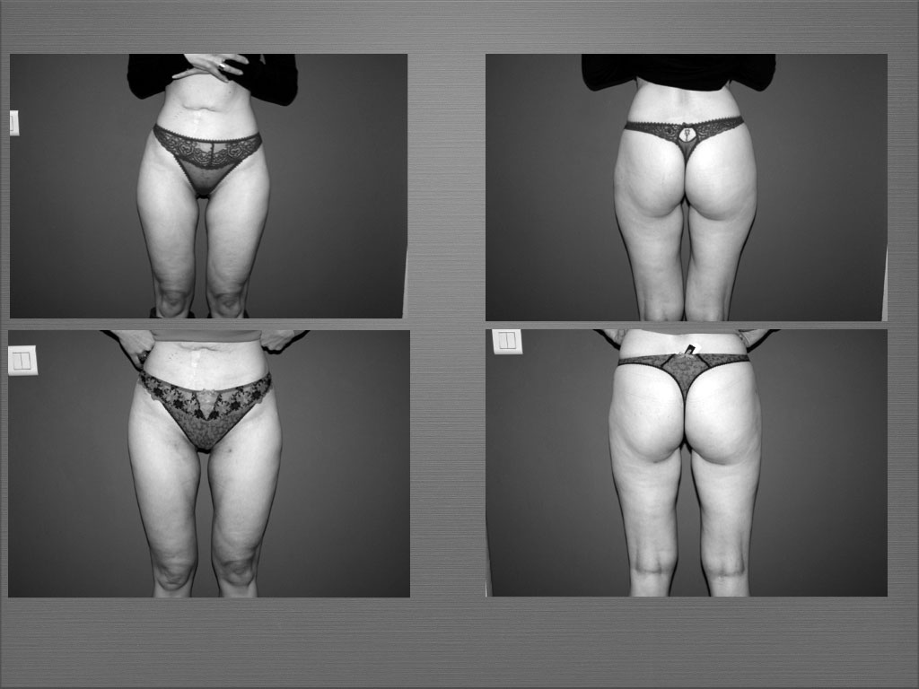 Chirurgie silhouette résultat 7