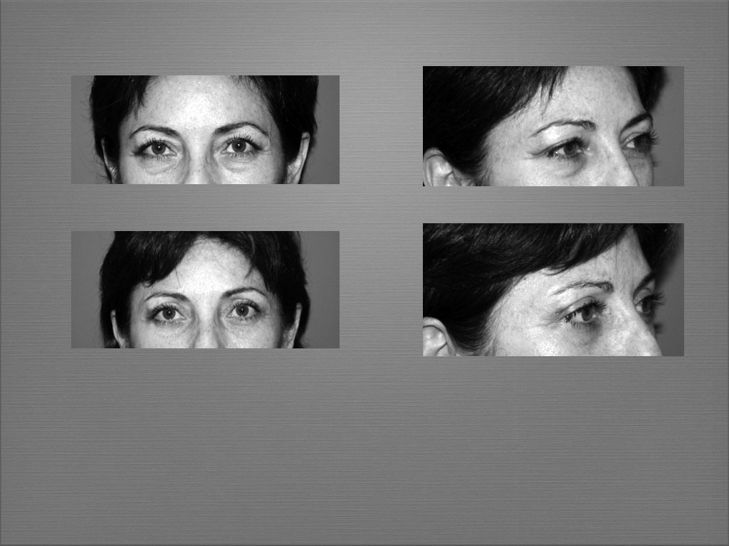 Chirurgie du visage résultat 3