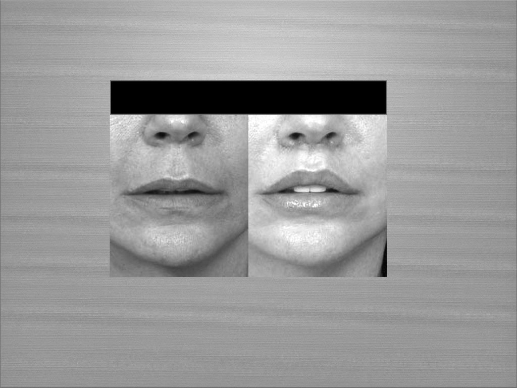 Chirurgie du visage résultat 4