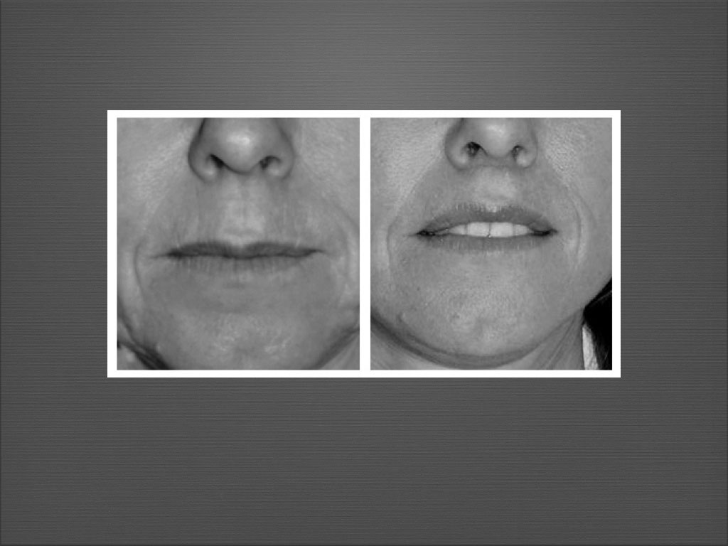 Chirurgie du visage résultat 5