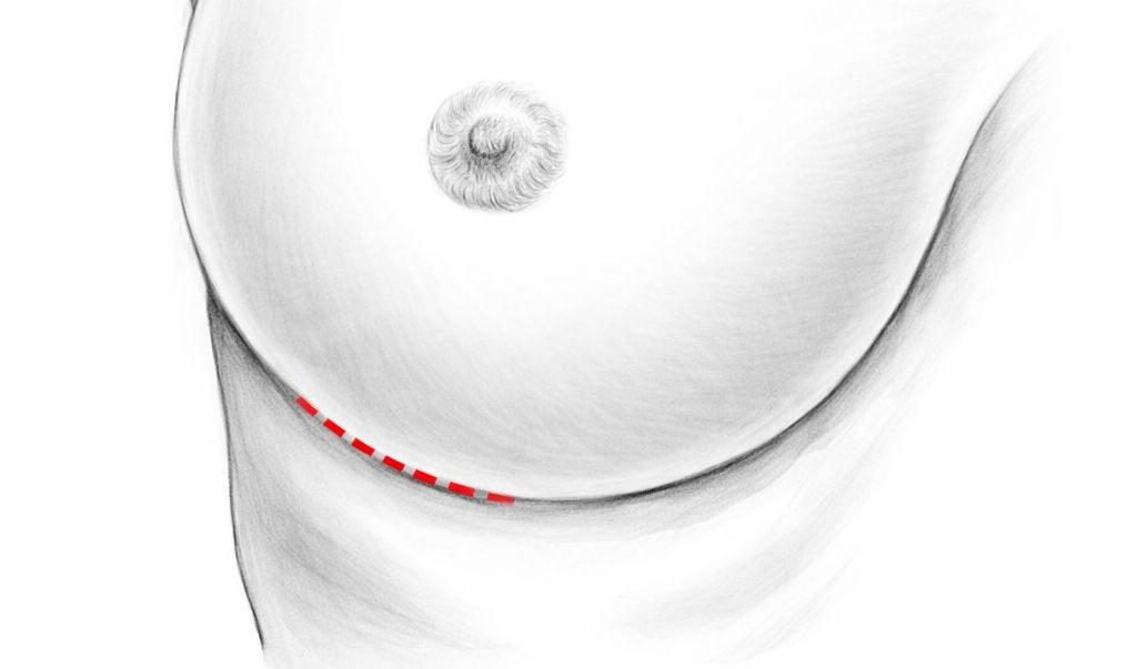LILA étape 1 : incision de 2 à 3 cm sous le pli du sein
