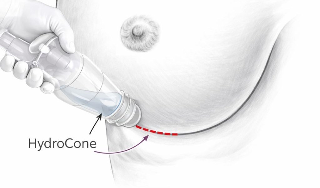 LILA étape 2 : insertion de l'implant en position pré-pectorale à l'aide d'un HydroCone