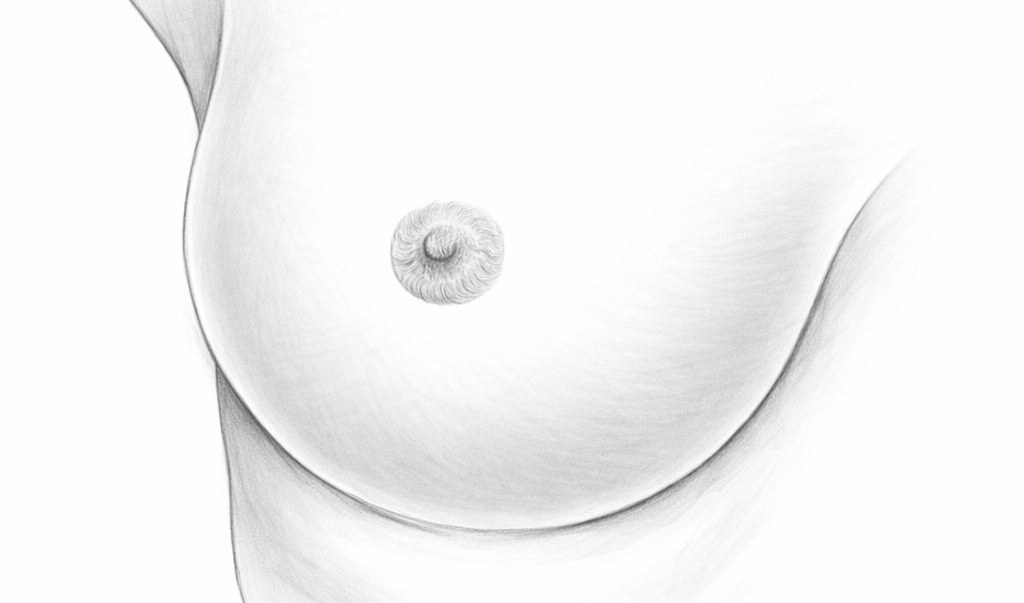 LILA étape 3 : fermeture de l'incision, cicatrice discrète sous le sein